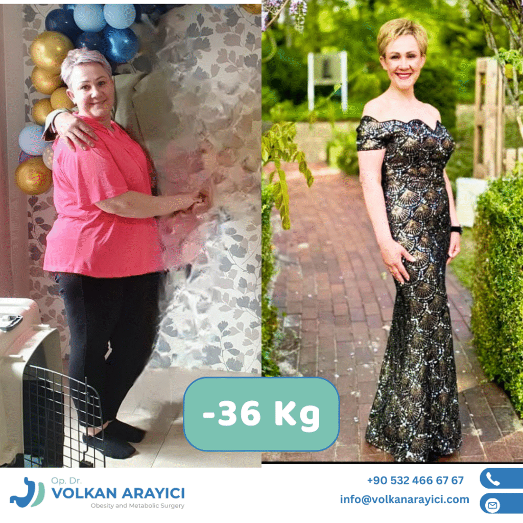 Bariatrische Chirurgie Türkei Vorher Nachher Bild