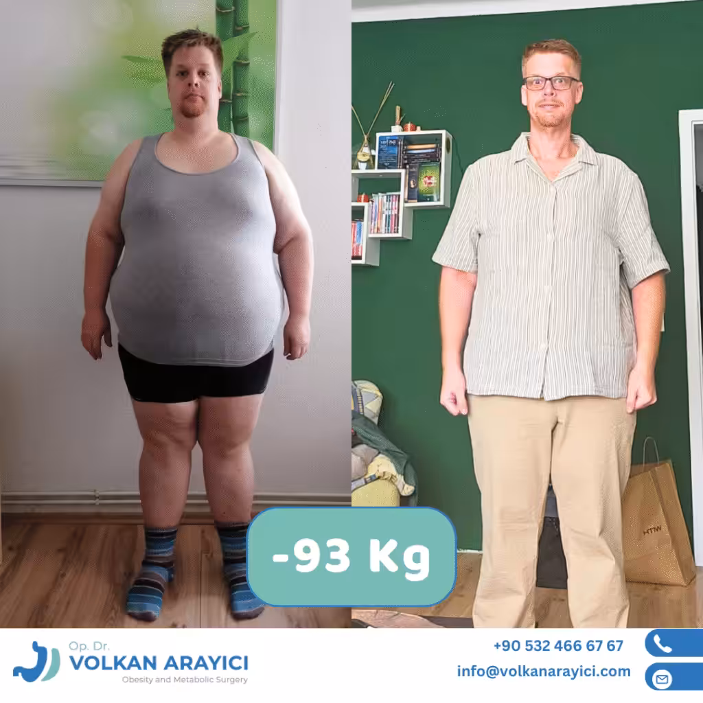 Volkan Arayıcı Klinik: Ihre Top-Adresse für Bariatrische Chirurgie in der Türkei magen op türkei vorher nachher