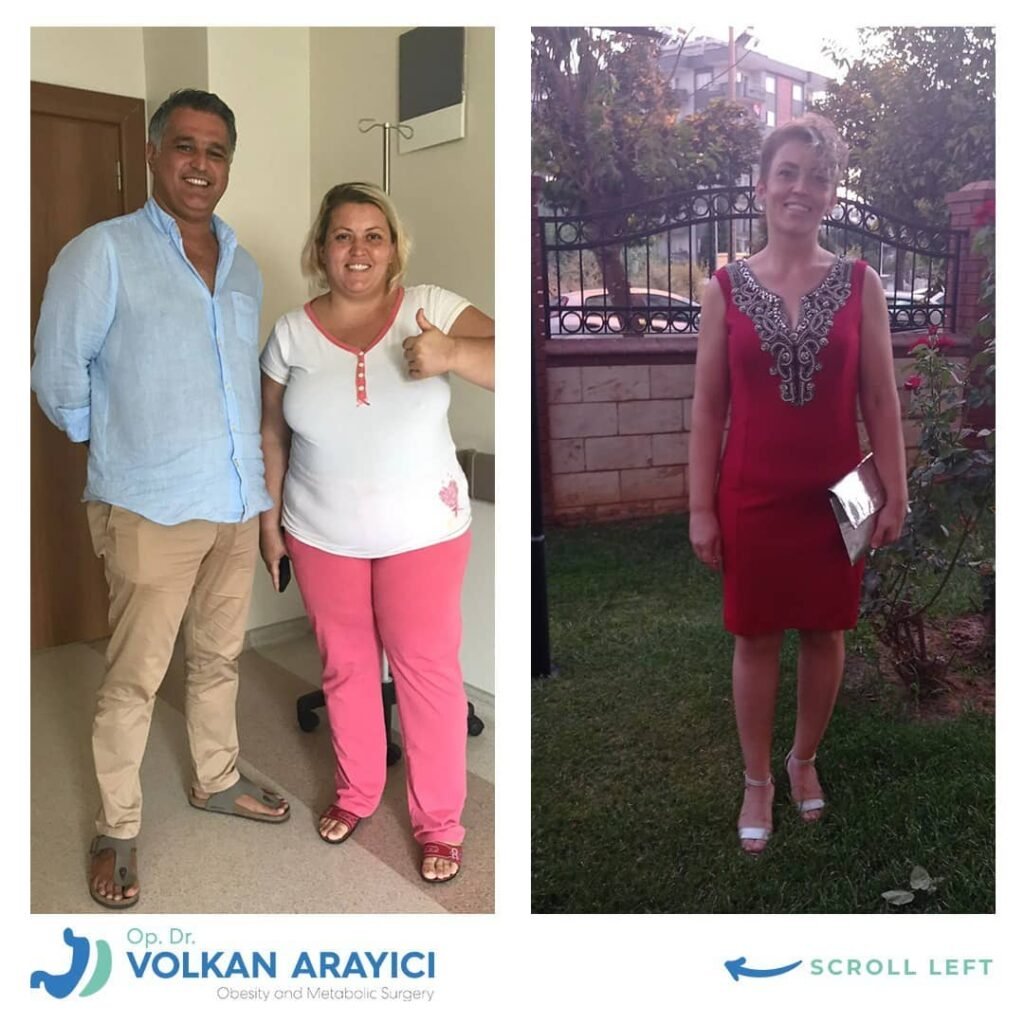 Adipositaschirurgie in der Türkei