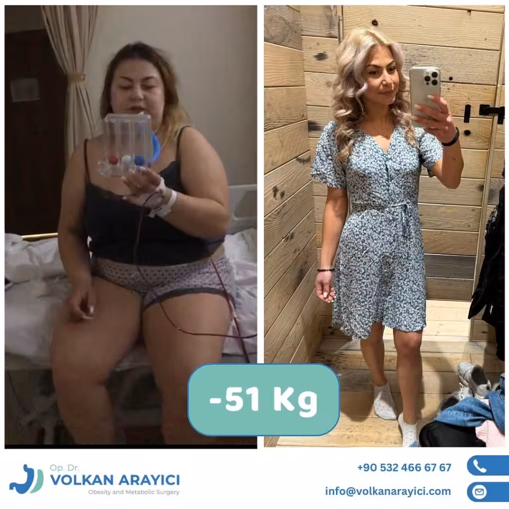 Gastric Sleeve Revision in Turkey Bariatric Revision in Turkey