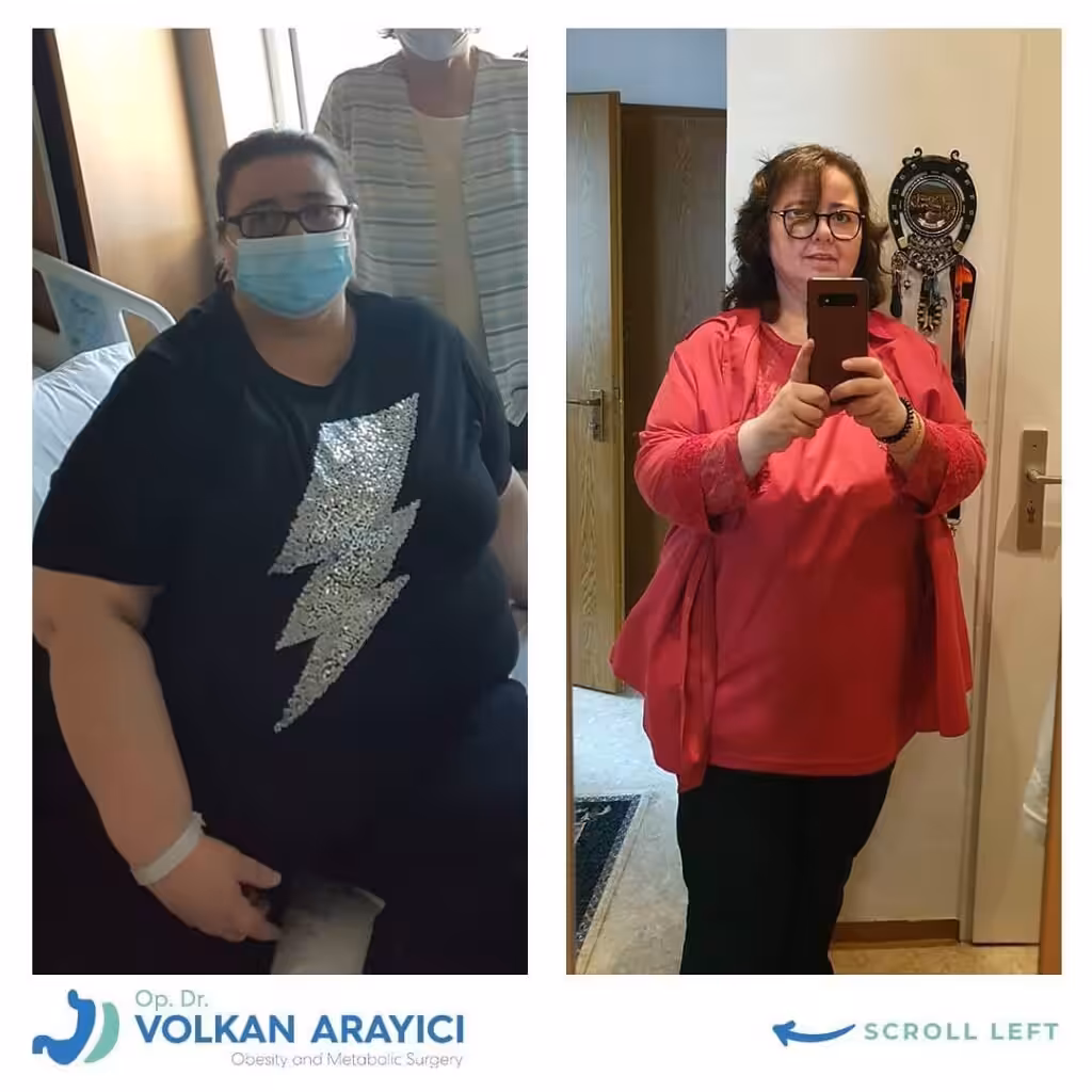 El Verdadero Costo de la Cirugía de Manga Gástrica en Turquía: Una Guía Completa de Precios 2026 Costos de la Manga Gástrica