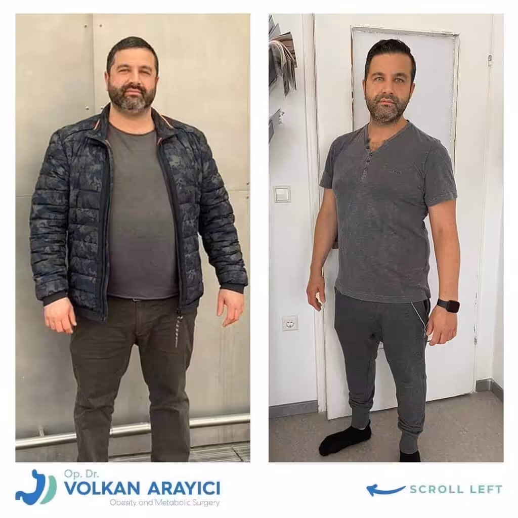 El Verdadero Costo de la Cirugía de Manga Gástrica en Turquía: Una Guía Completa de Precios 2026 Cuánto Cuesta una Bypass Gástrico