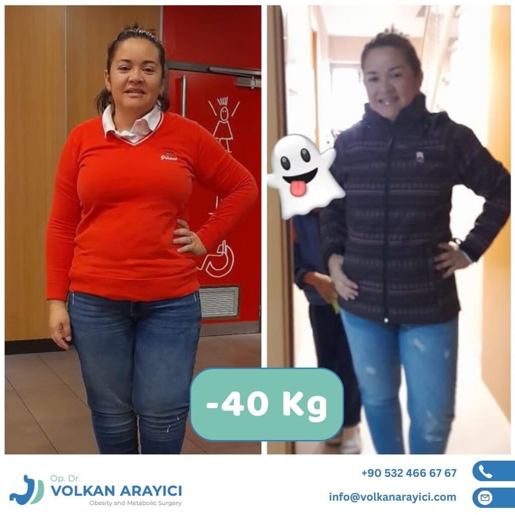 Gastric Sleeve Revision in Turkey Gastric Reduction Revision in Turkey