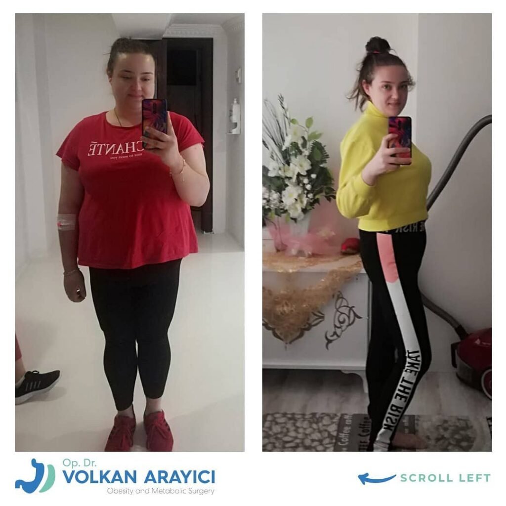 gastric sleeve turkey all-inclusive