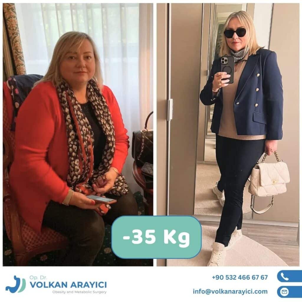 Magen OP Türkei vorher nachher