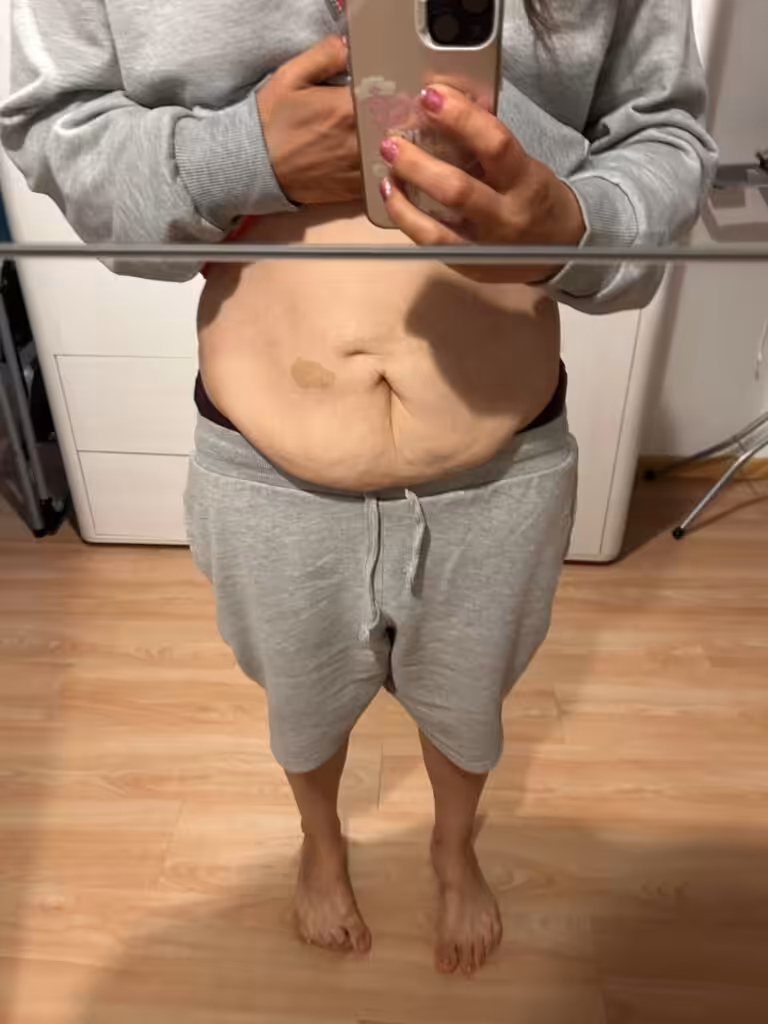 Überschüssige haut Schlauchmagen op vorher nachher Magen OP Vorher Nachher hängender Bauch