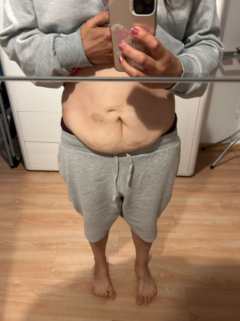 Magen OP Vorher Nachher