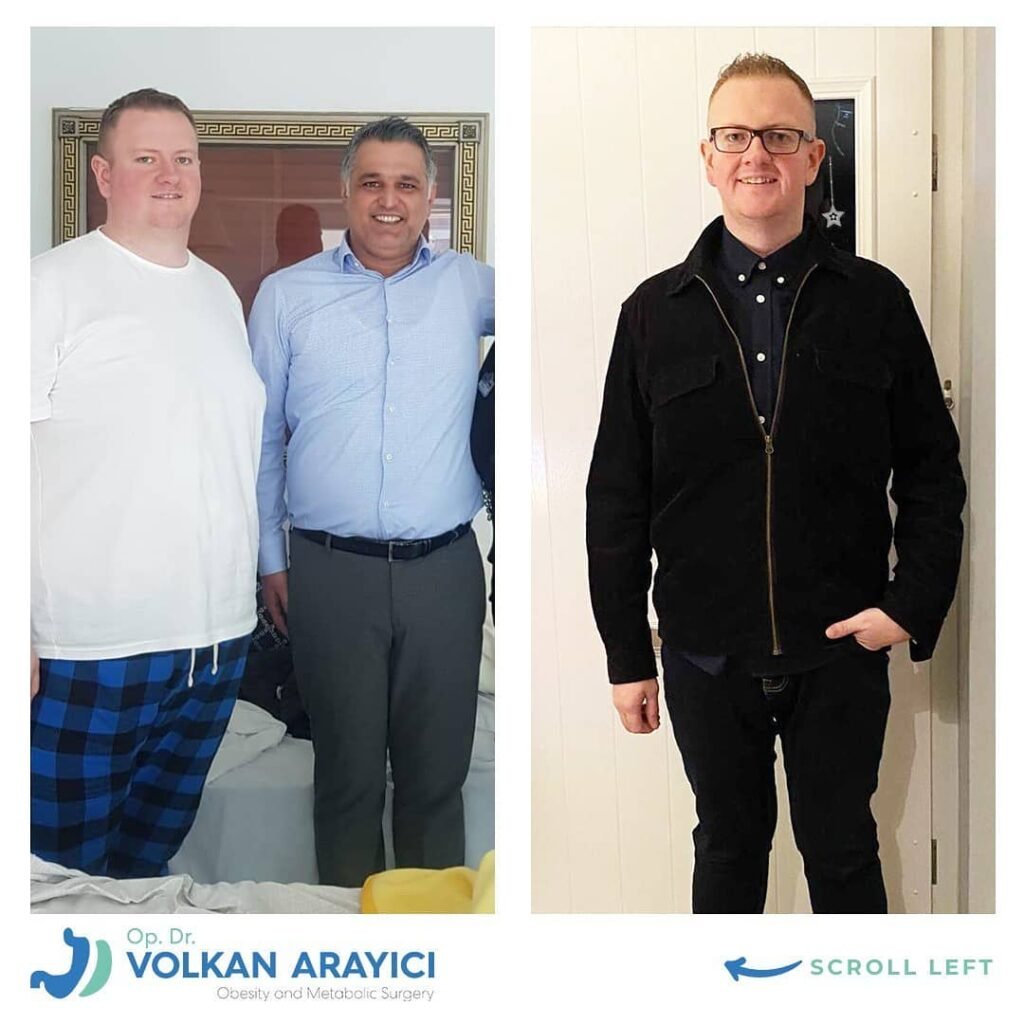 Magenverkleinerung Türkei Vorteile