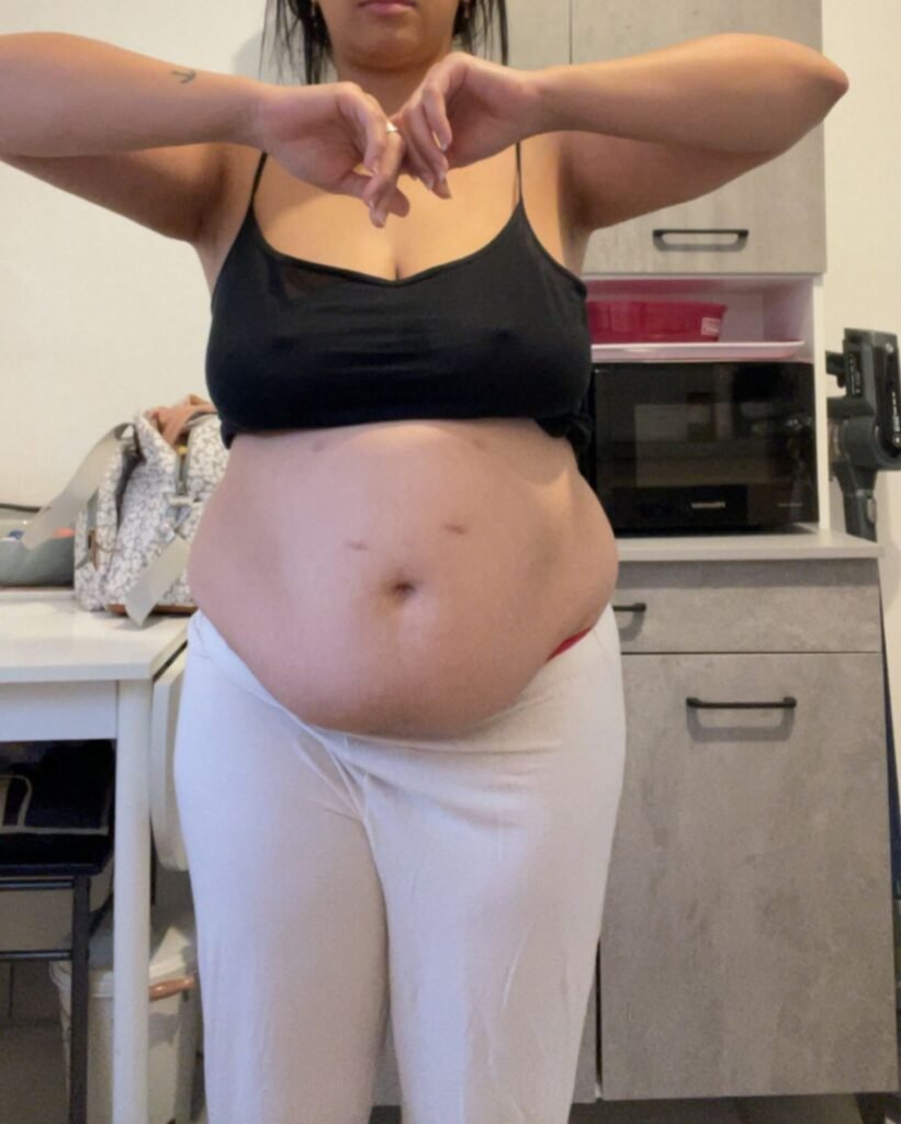 Magenverkleinerung vorher nachher Haut