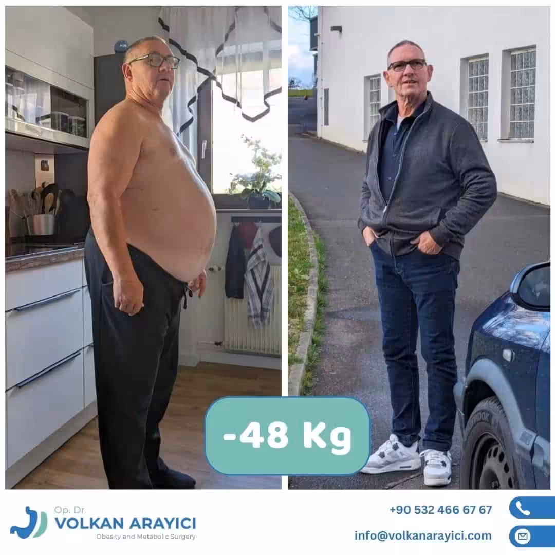 Paquete de Bypass Gástrico Turquía