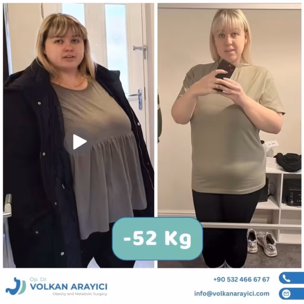 Paquete de Reducción Gástrica Turquía