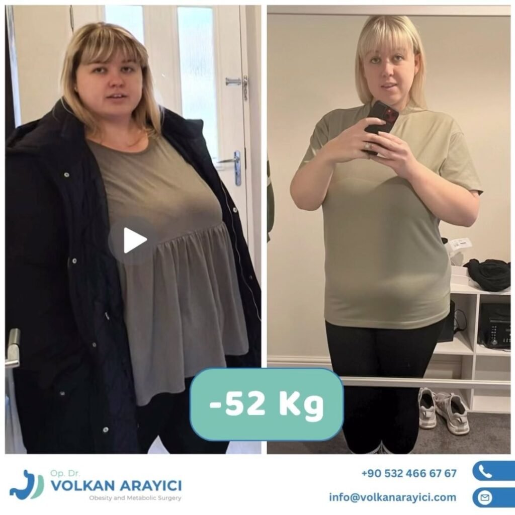 Paquete de Reducción Gástrica Turquía 