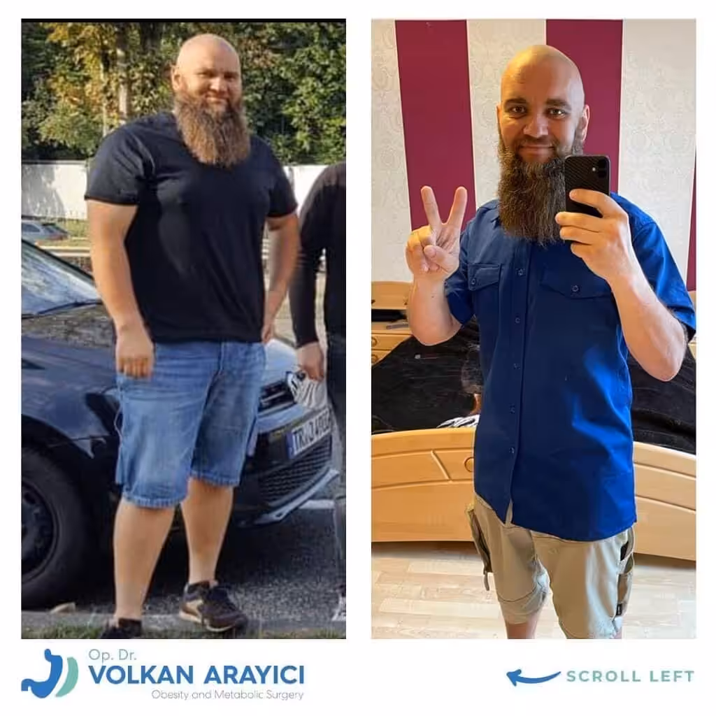 Bariatric Surgery Turkey best bariatric surgery in turkey