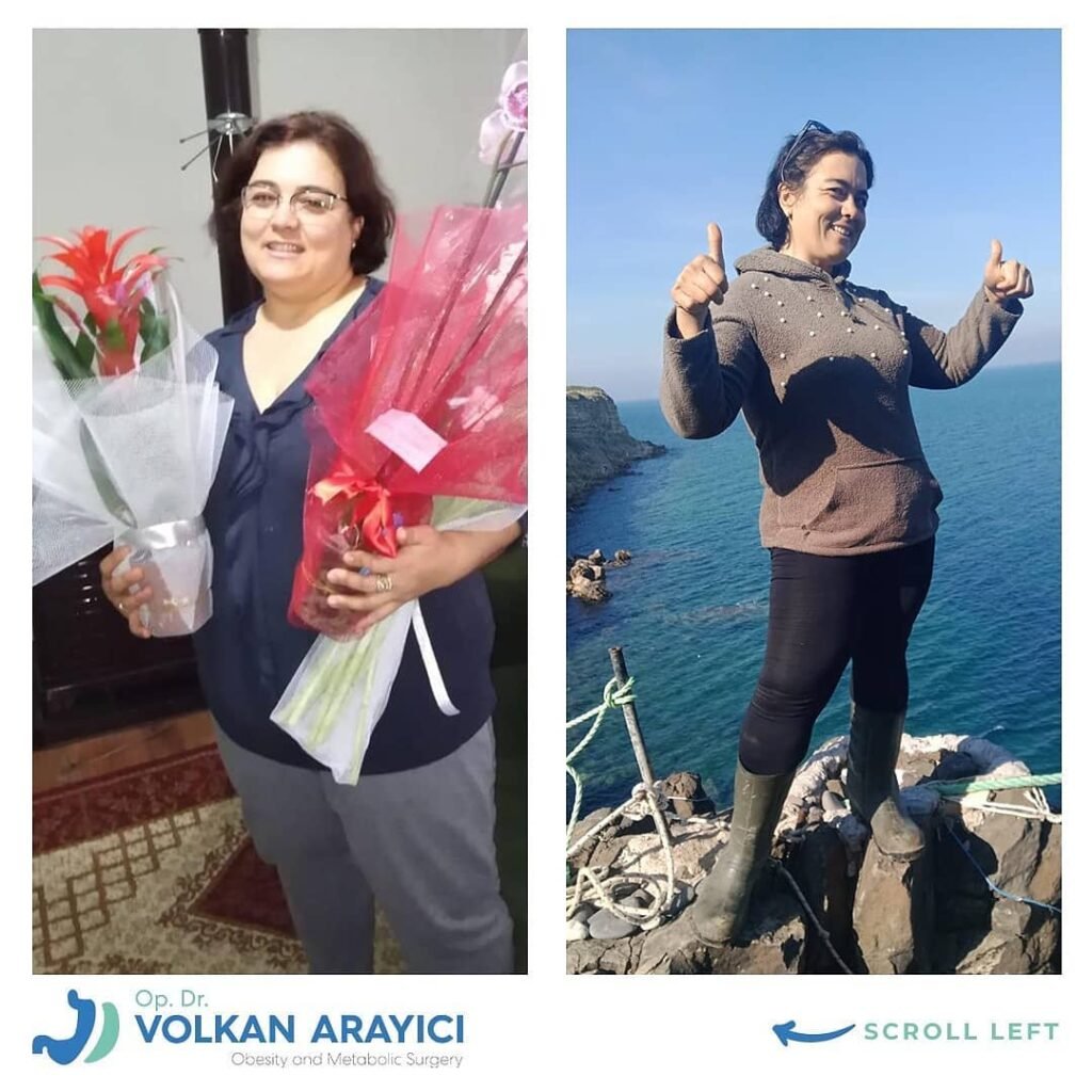 cirugía bariátrica turquía precio