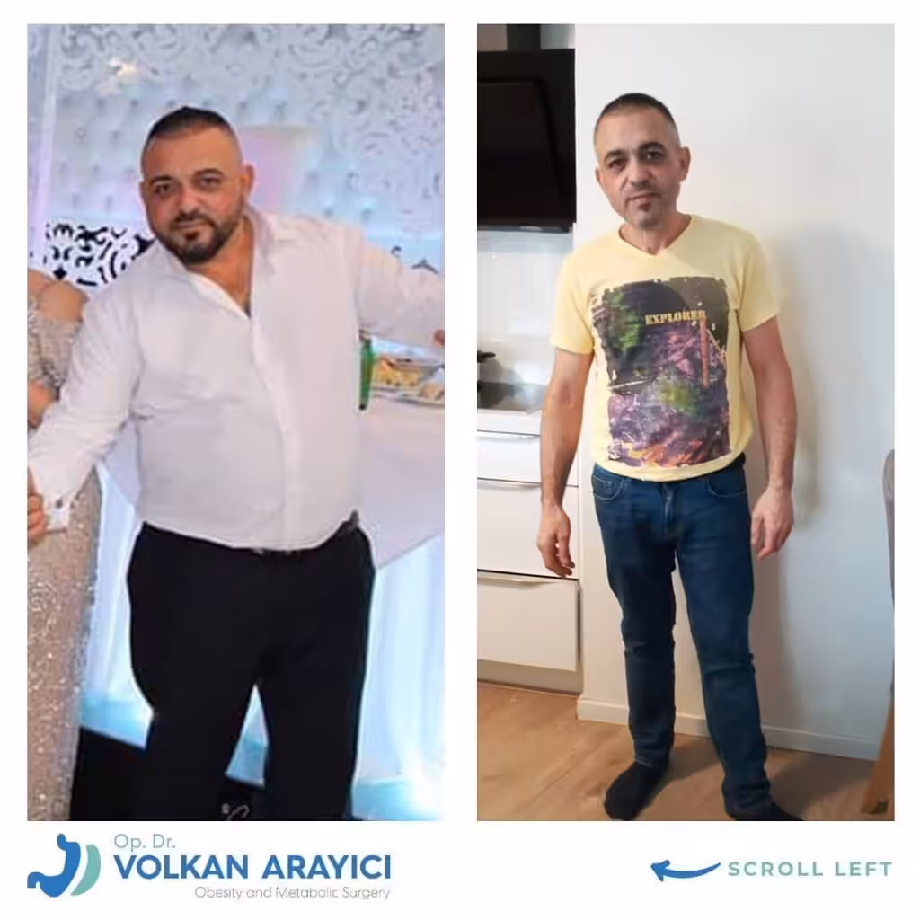 cirugía gástrica Turquía