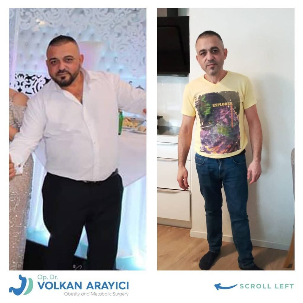 cirugía gástrica Turquía