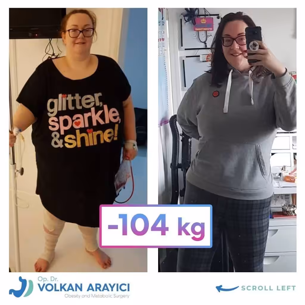 cirugía gástrica en Esmirna