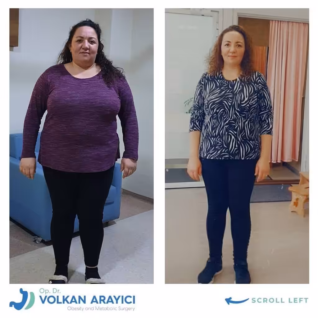 cirugía gástrica en Turquía