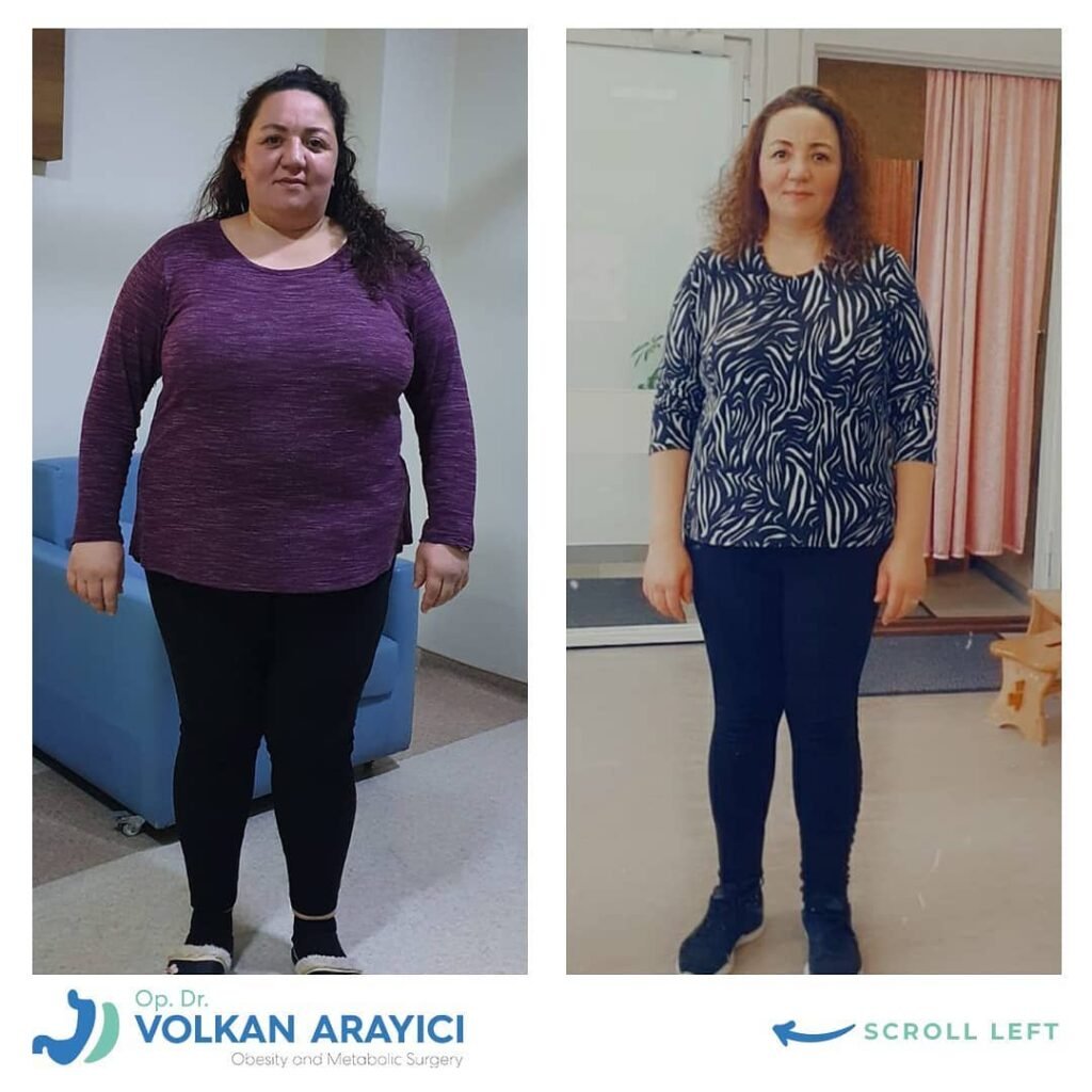 cirugía gástrica en Turquía