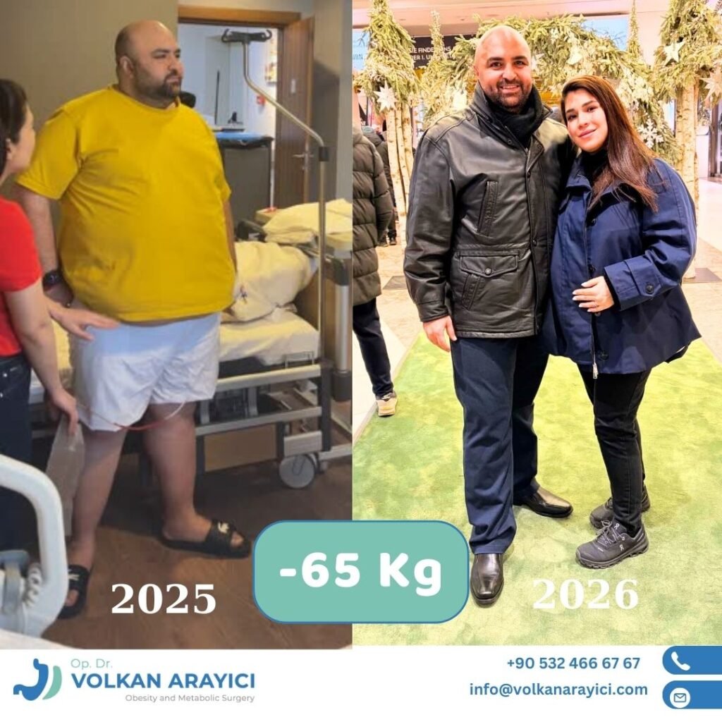 gastric sleeve before and after