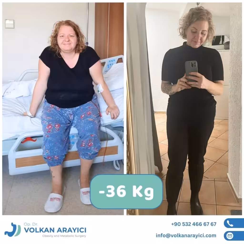 Gastric Sleeve Revision in Turkey gastric sleeve revision in Turkey