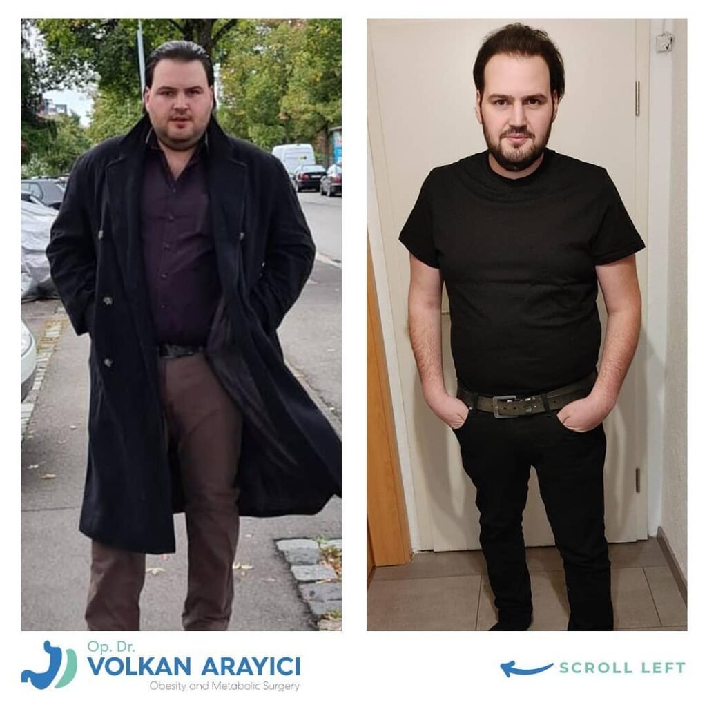 gastric sleeve turkey all inclusive