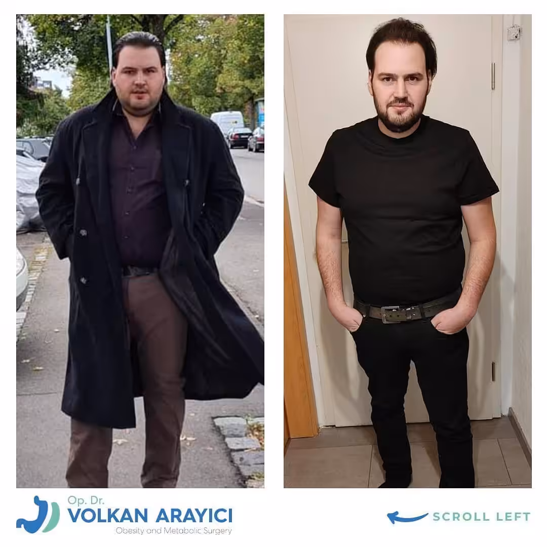 gastric sleeve turkey all inclusive