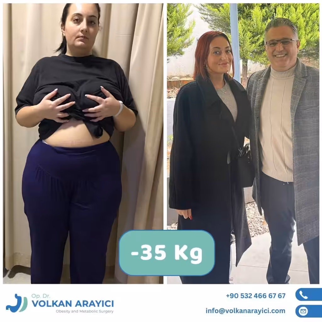 Gastric Surgery in Turkey Costs and Best Clinic gastric surgery Turkey before and after