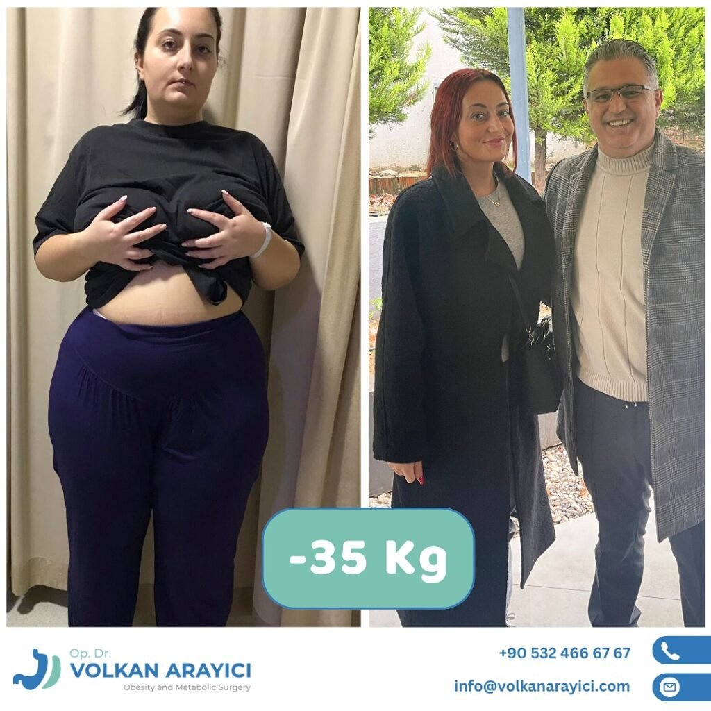 gastric surgery Turkey before and after