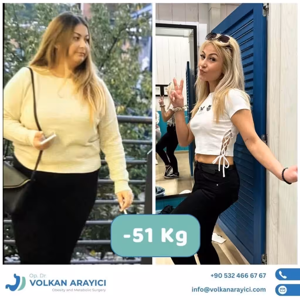 Gastric Surgery in Turkey Costs and Best Clinic gastric surgery cost Turkey