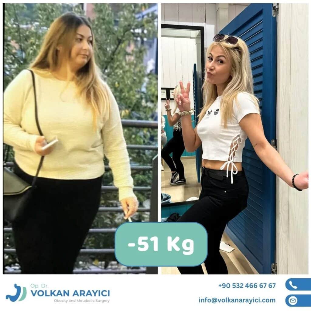 gastric surgery cost Turkey