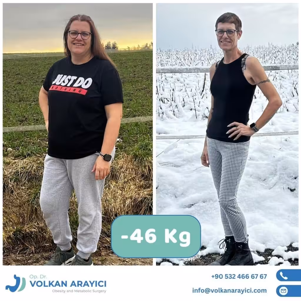 Gastric Surgery in Turkey Costs and Best Clinic gastric surgery Turkey reviews