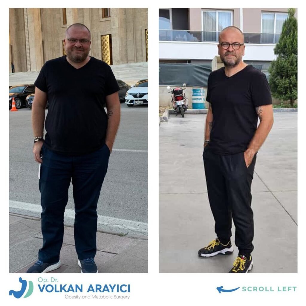 magen op türkei beste klinik vorher nachher