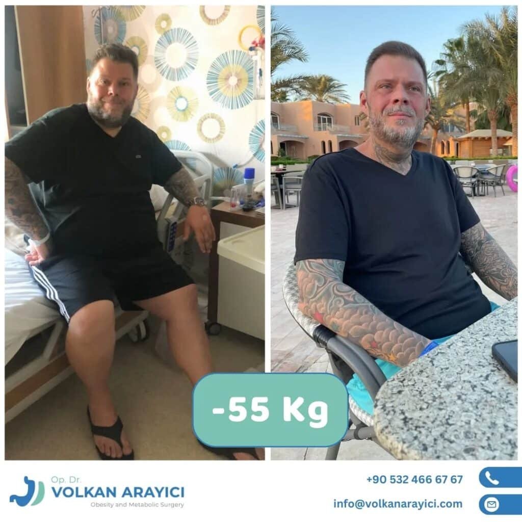 Magen OP Türkei Kosten