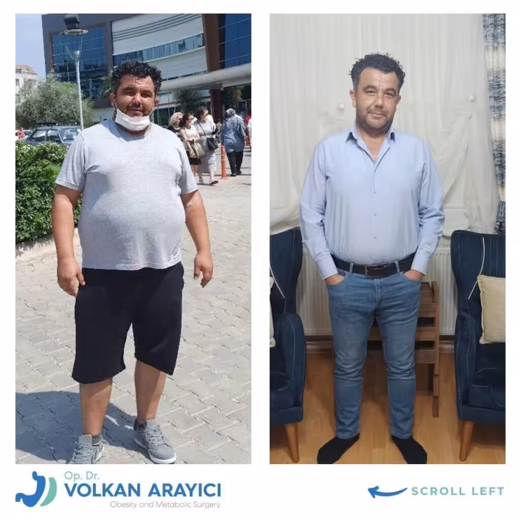 Überschüssige haut Schlauchmagen op vorher nachher magenbypass bilder vorher nachher