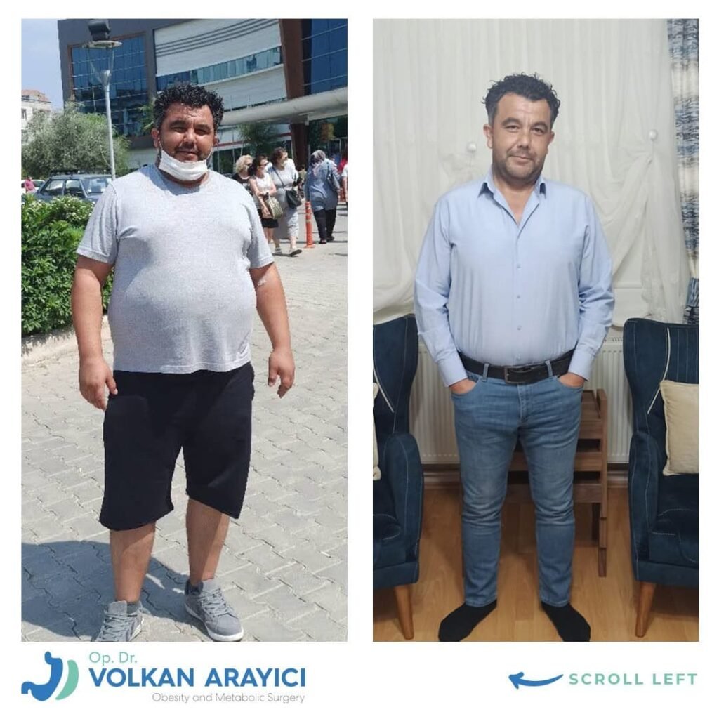 magenbypass bilder vorher nachher