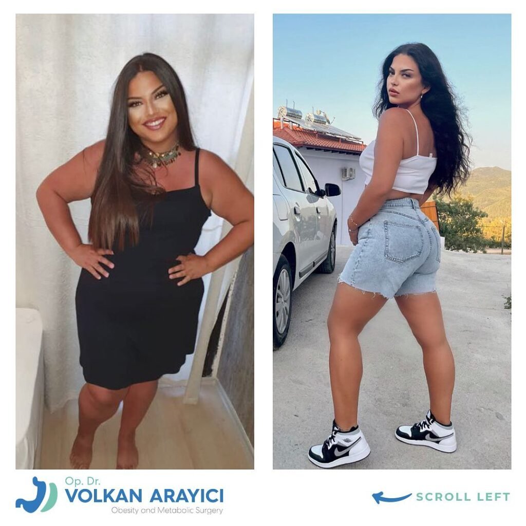 magenverkleinerung in der türkei vorher nachher