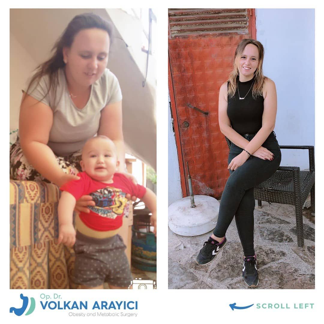 magenverkleinerung kosten Türkei