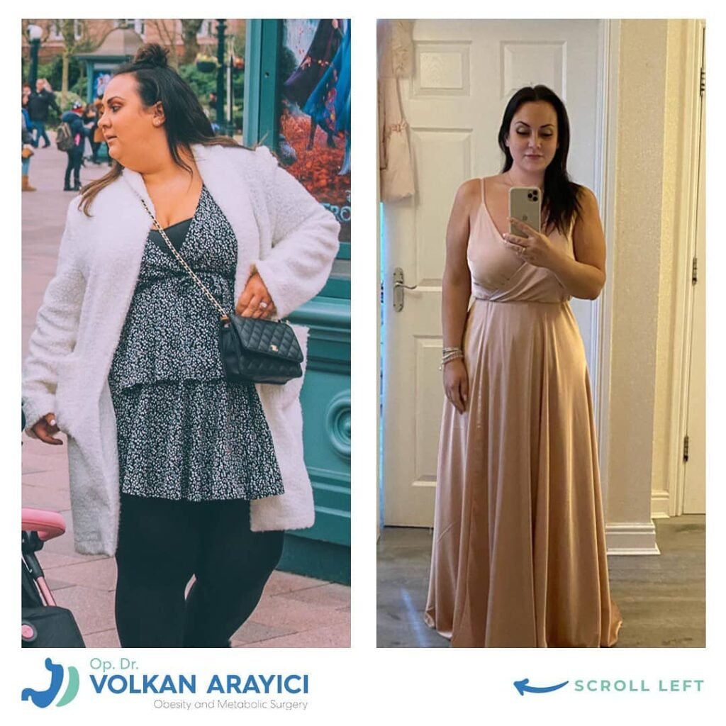 manga gastrica en turquia precio