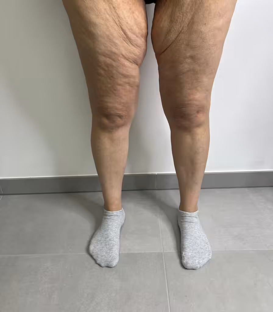 Gastric Sleeve Before and After skin sagging after gastric sleeve