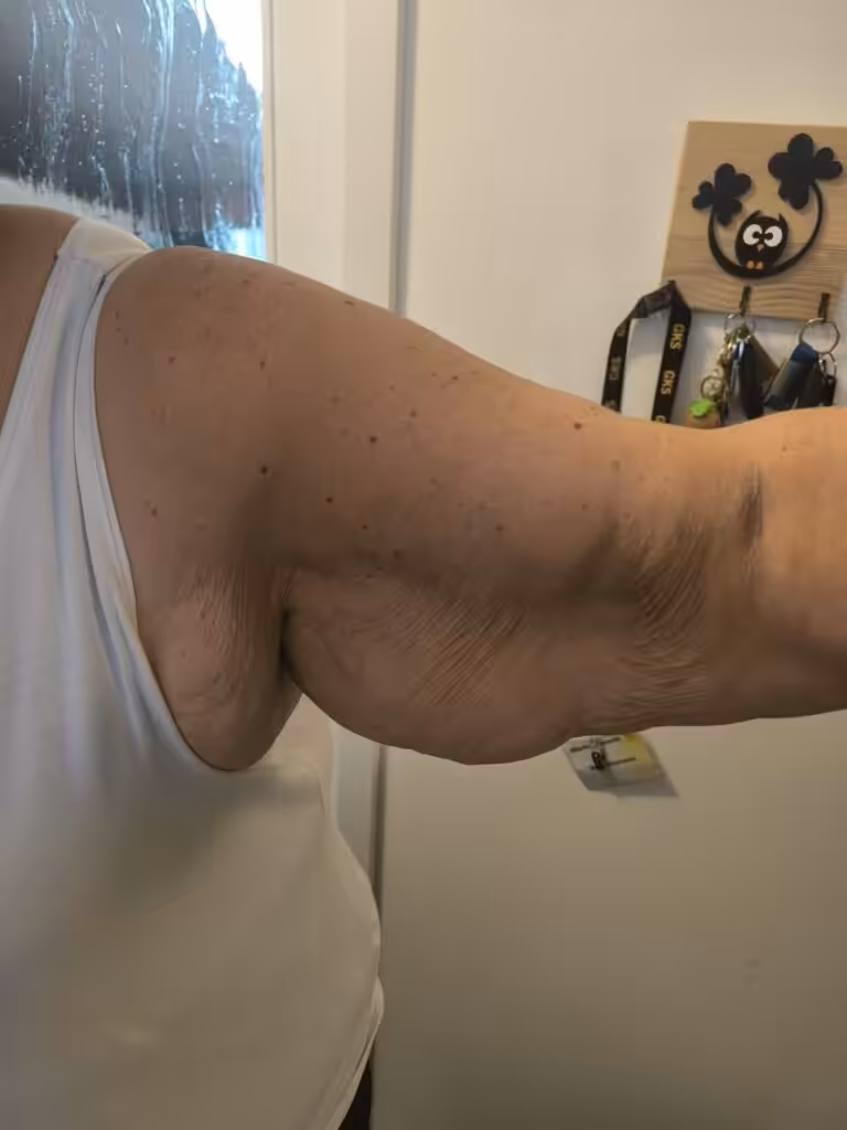 Gastric Sleeve Before and After skin sagging after gastric sleeve surgery