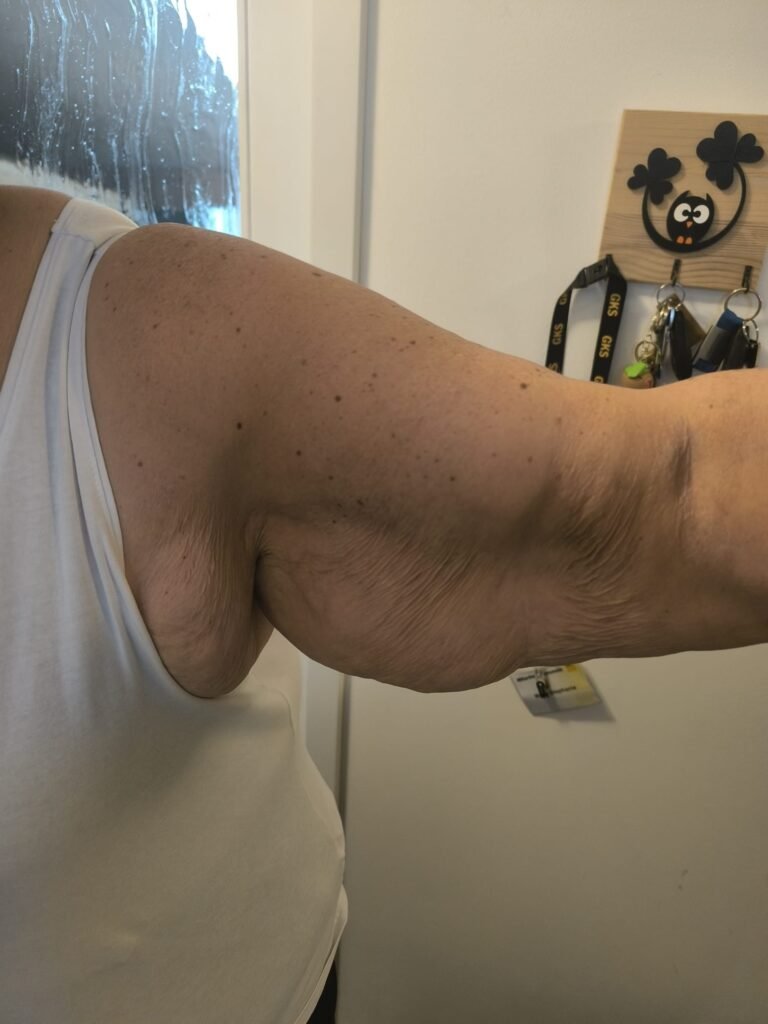 skin sagging after gastric sleeve surgery