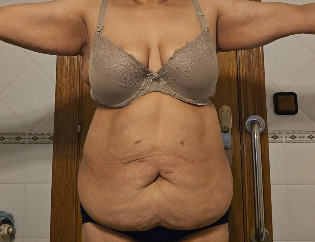 überschüssige haut nach schlauchmagen op