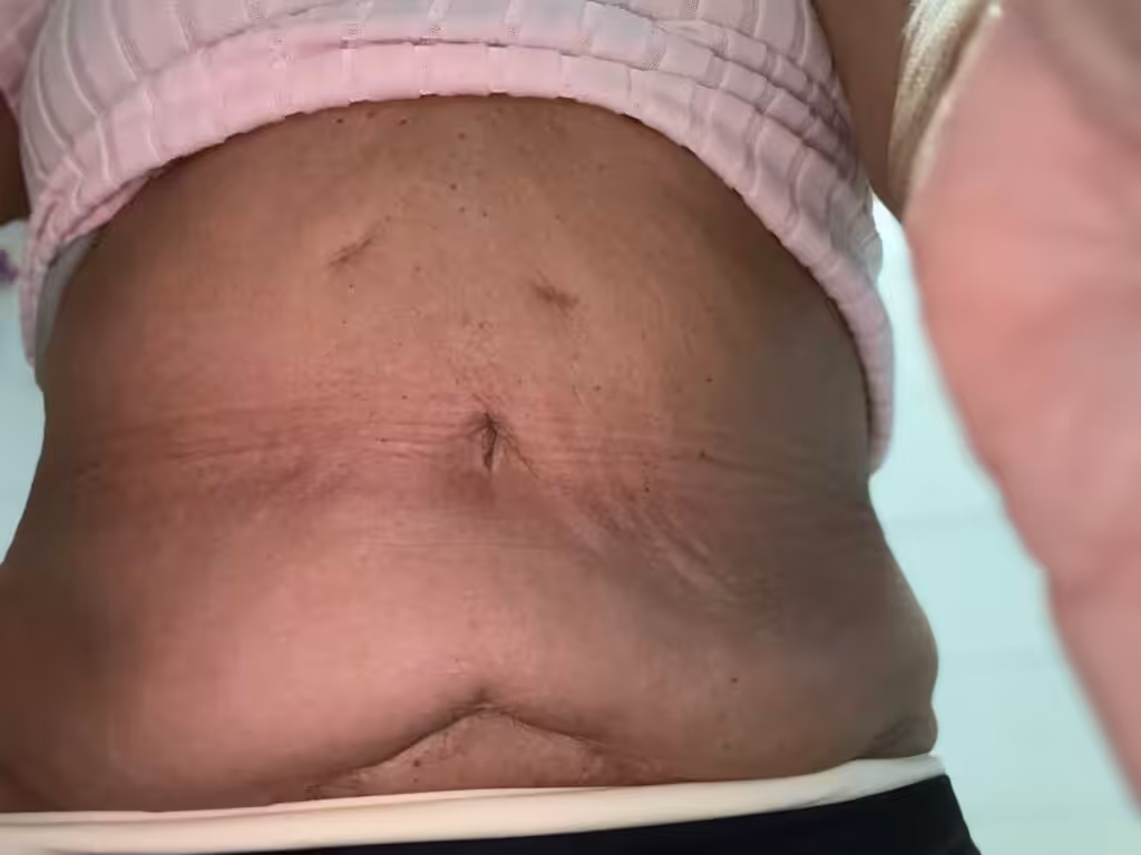 Überschüssige haut Schlauchmagen op vorher nachher überschüssige haut schlauchmagen op vorher nachher