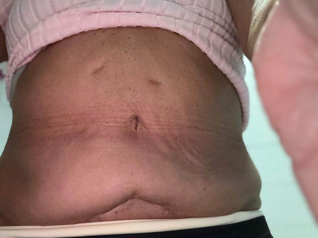 überschüssige haut schlauchmagen op vorher nachher