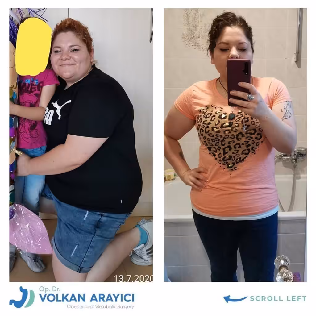 weight gain after gastric bypass