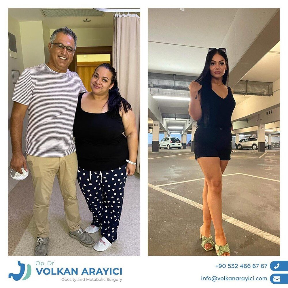 weight gain after gastric sleeve surgery